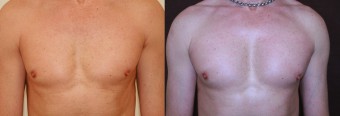 Vlevo před, vpravo po augmentaci prsů
