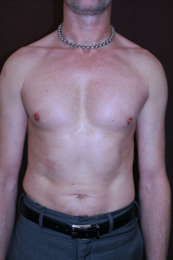 Celkový pohled na muže po augmentaci prsů a liposukci